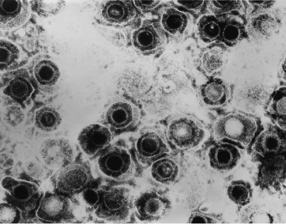 Virus chống lại ung thư hắc tố bào (melanoma) đã nhận được phê duyệt của Cơ quan Quản lý Thuốc và Thực phẩm Hoa Kỳ