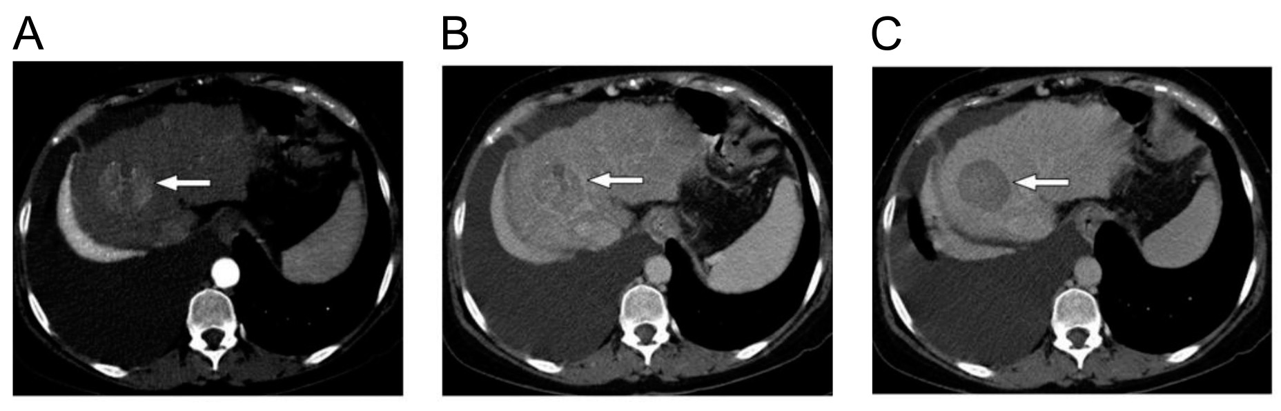 Ung thư biểu mô tế bào gan (hepatocellular carcinoma)