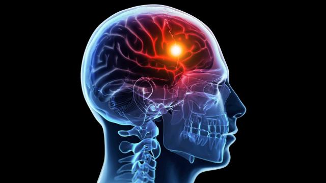Kỹ thuật mới: Chẩn đoán nhanh đột quỵ não bằng hạt nano gắn enzyme