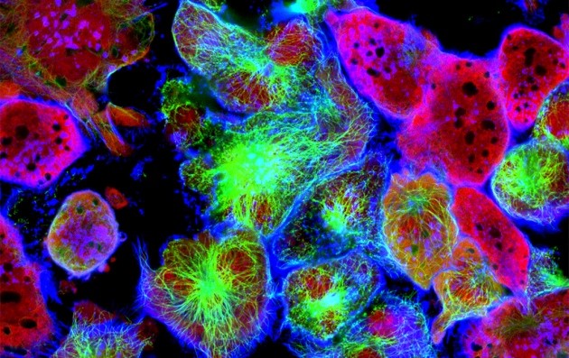 Lỗi “đánh máy” của DNA được xem là nguyên nhân của phần lớn các đột biến ung thư