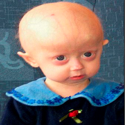 Progeria - căn bệnh hiếm về lão hóa sớm