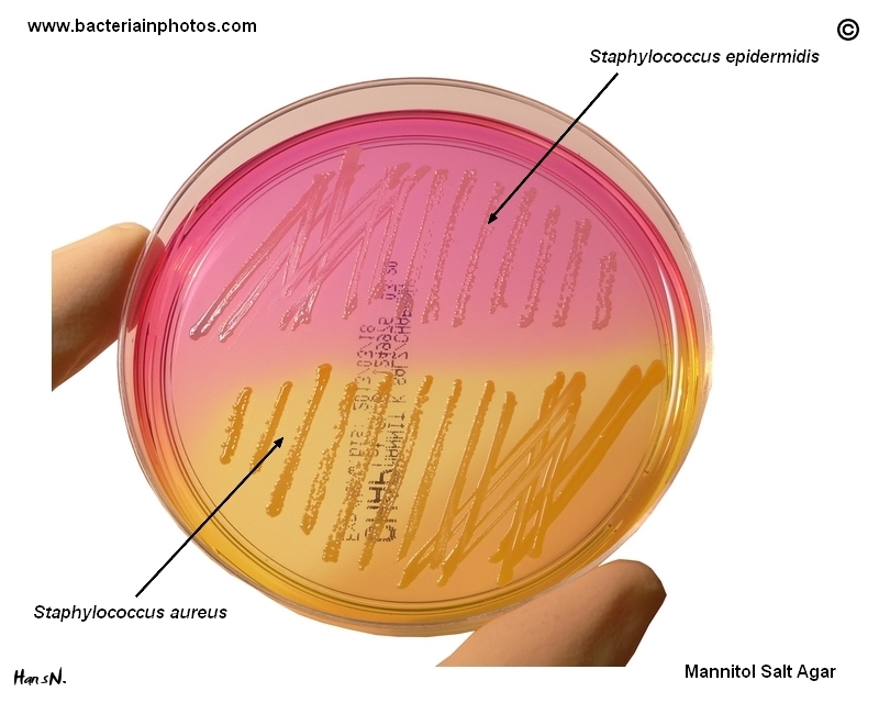 Hoạt chất chống ung thư ở chủng Staphylococcus epidermidis hội sinh trên da